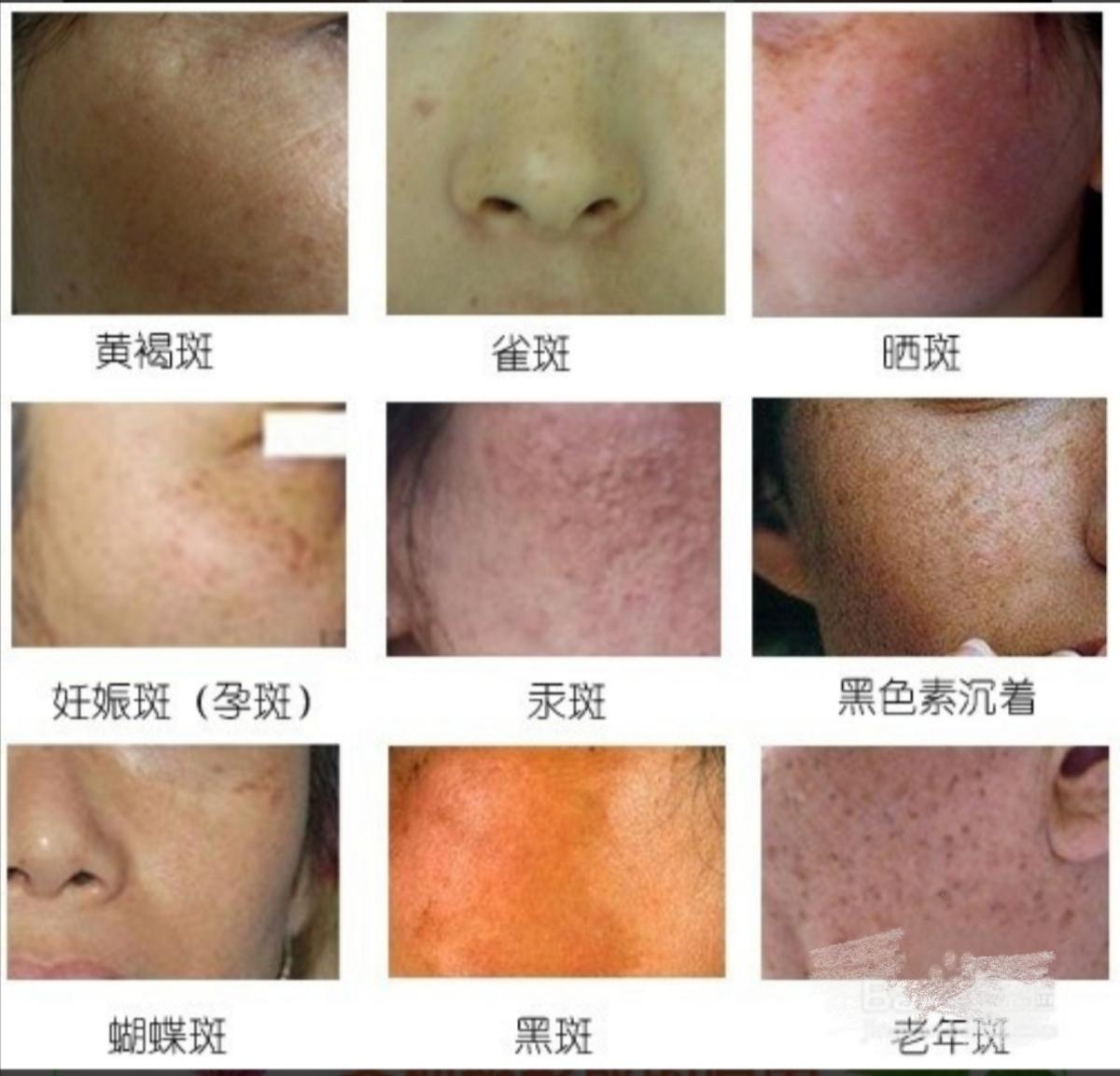 夏日逆袭！斑点一键“消失术”