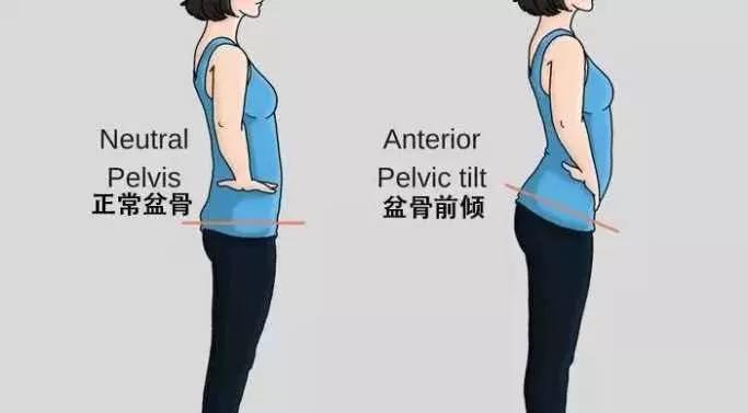 别让“骨盆前倾”毁了你的体态与健康