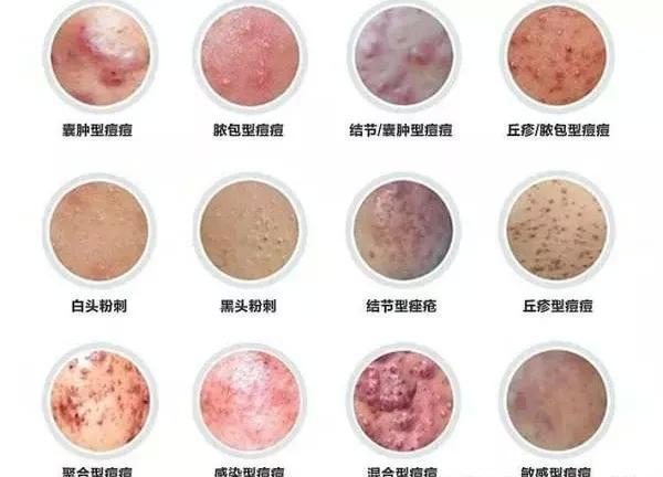 别再无效战痘！抓住这个黄金时机，和痘痘说拜拜