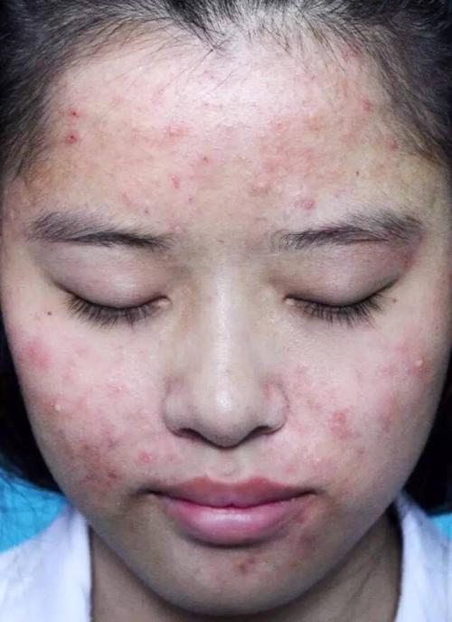 10元战痘秘籍，痘痘肌必看！