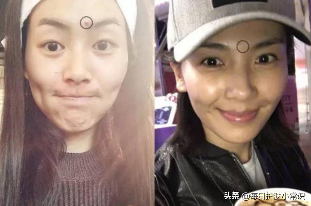 告别“战痘”烦恼，三款自制面膜来救场！