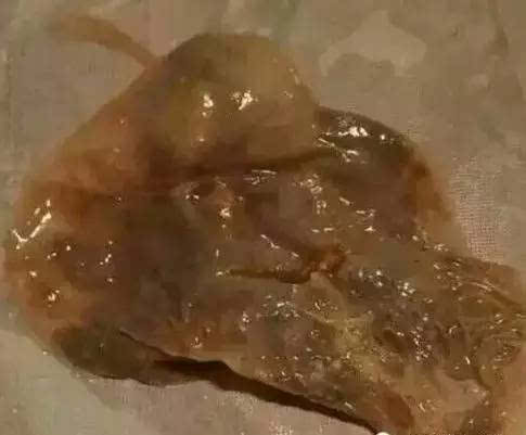 别慌！女性子宫囊肿大揭秘