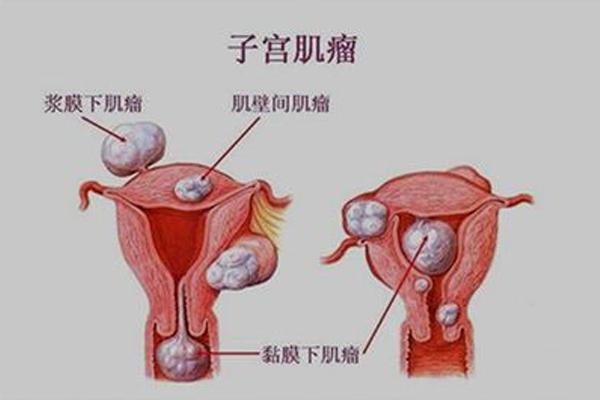 女性必知：子宫肌瘤那些事儿