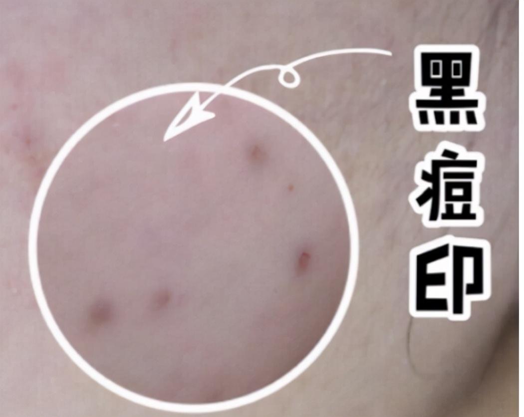 痘印大揭秘：红痘印与黑痘印的对决