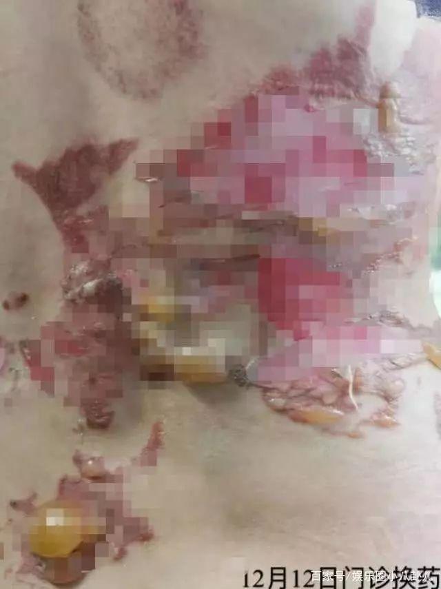 拔罐祛体湿，安全是前提！