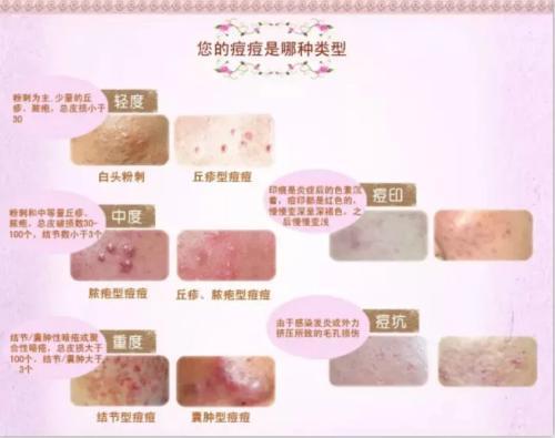 战“痘”秘籍大公开：跟恼人痘痘说拜拜