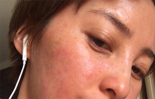 急救脸上过敏，冷镇敷面真的最有效？